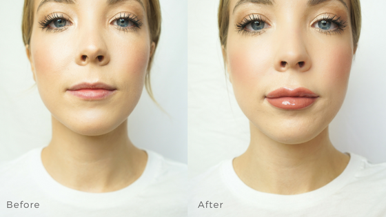 Before and after: Lip Filler Edition 