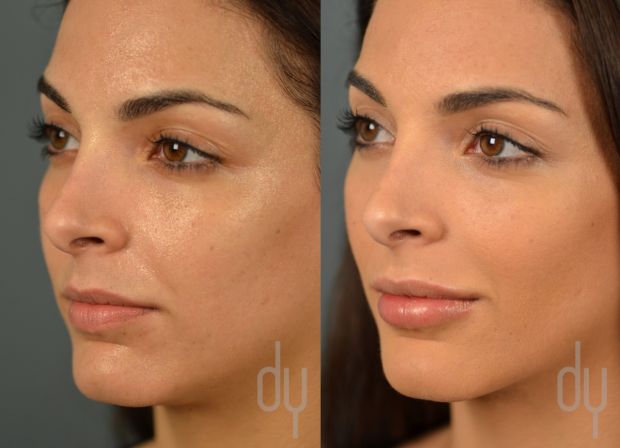 Before and after: Lip Filler Edition 