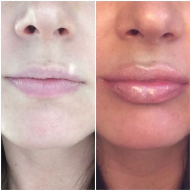 Before and after: Lip Filler Edition 