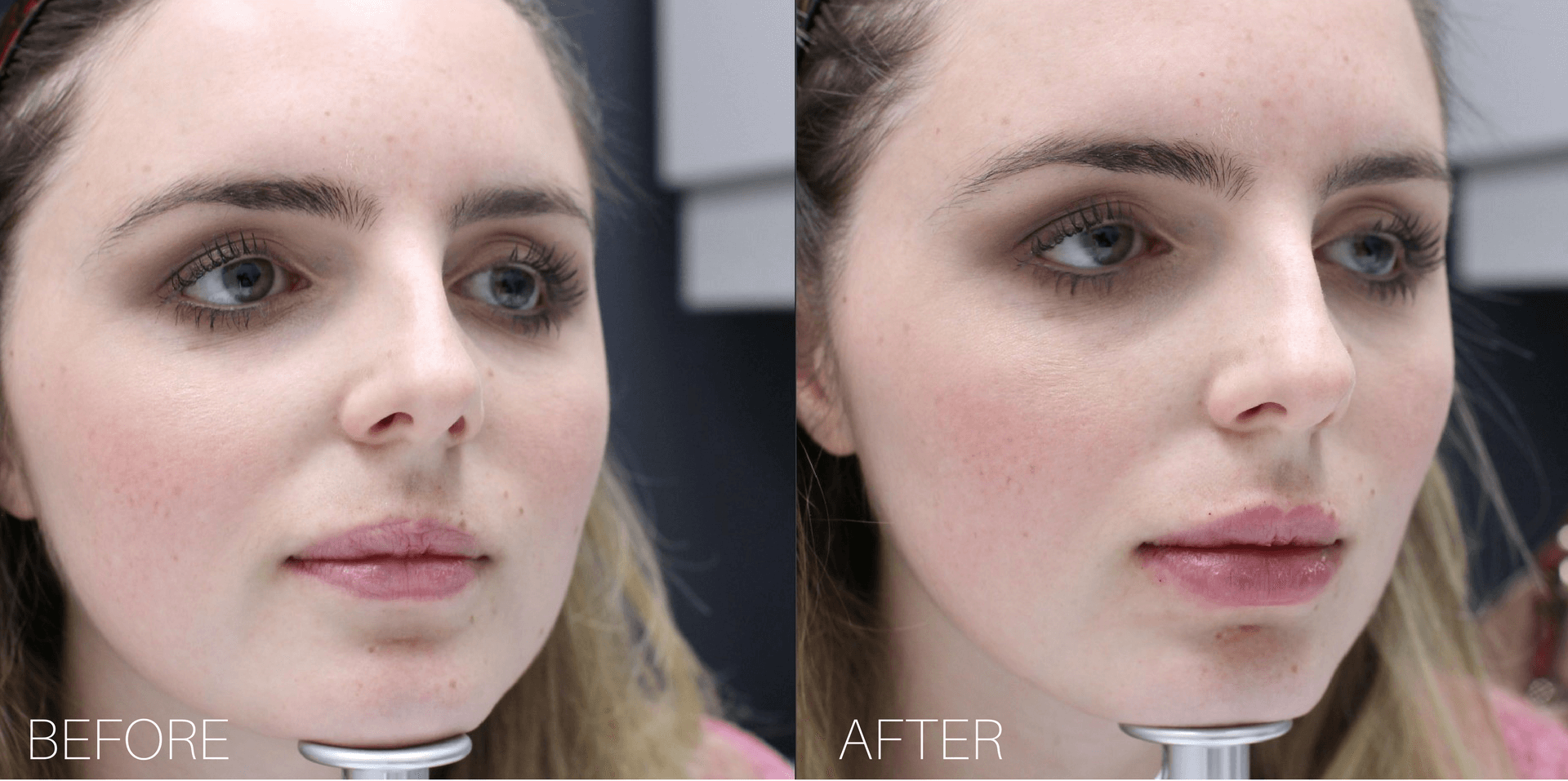 Before and after: Lip Filler Edition 