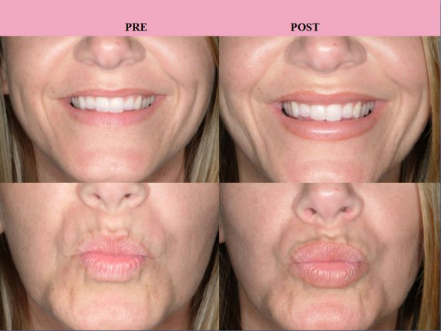 Before and after: Lip Filler Edition 