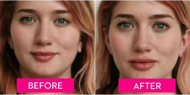 Before and after: Lip Filler Edition 