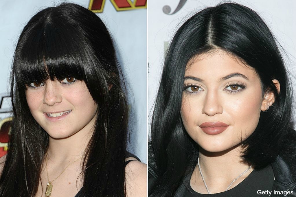 Before and after: Lip Filler Edition 