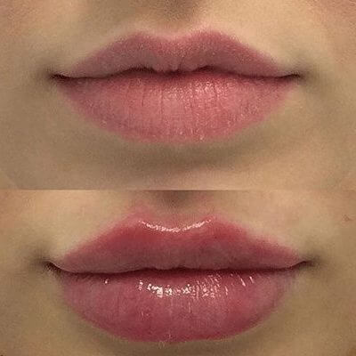 Before and after: Lip Filler Edition 