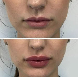 Before and after: Lip Filler Edition 