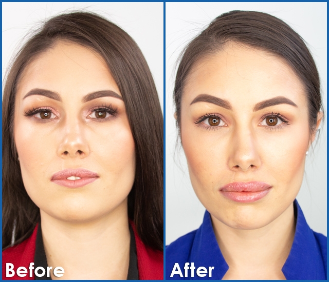 Before and after: Lip Filler Edition 