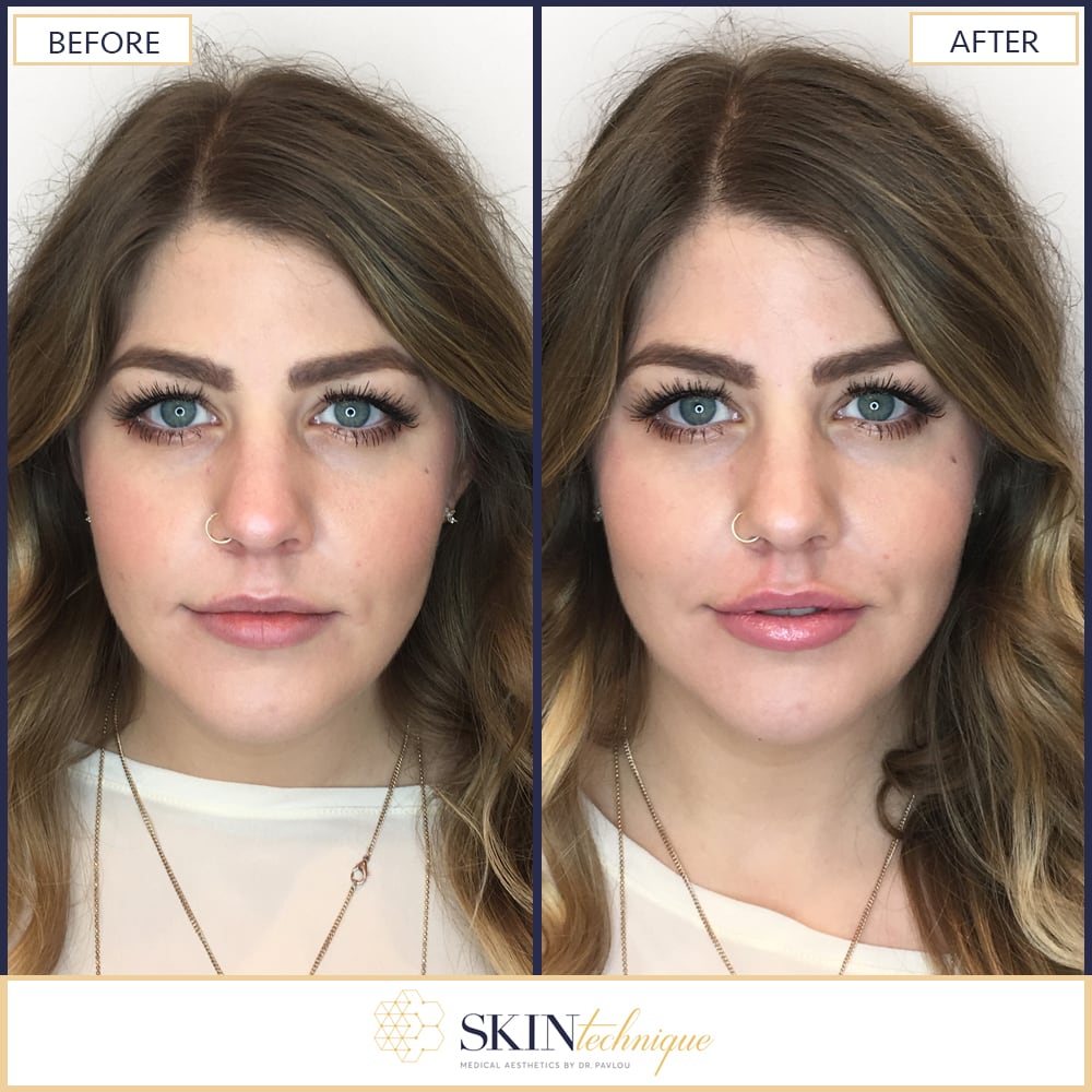 Before and after: Lip Filler Edition 