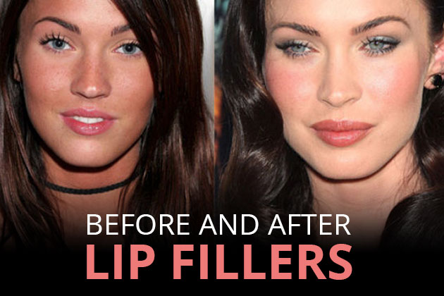 Before and after: Lip Filler Edition 