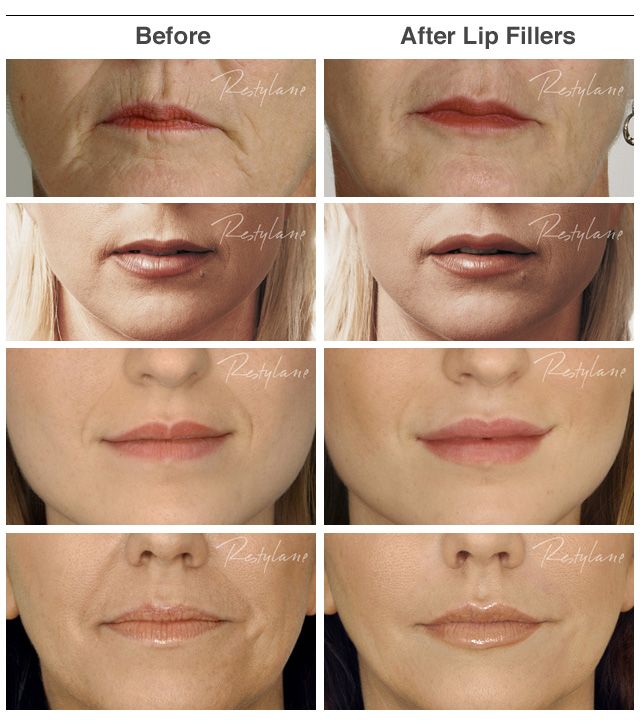 Before and after: Lip Filler Edition 
