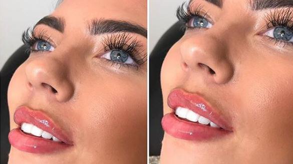 Before and after: Lip Filler Edition 