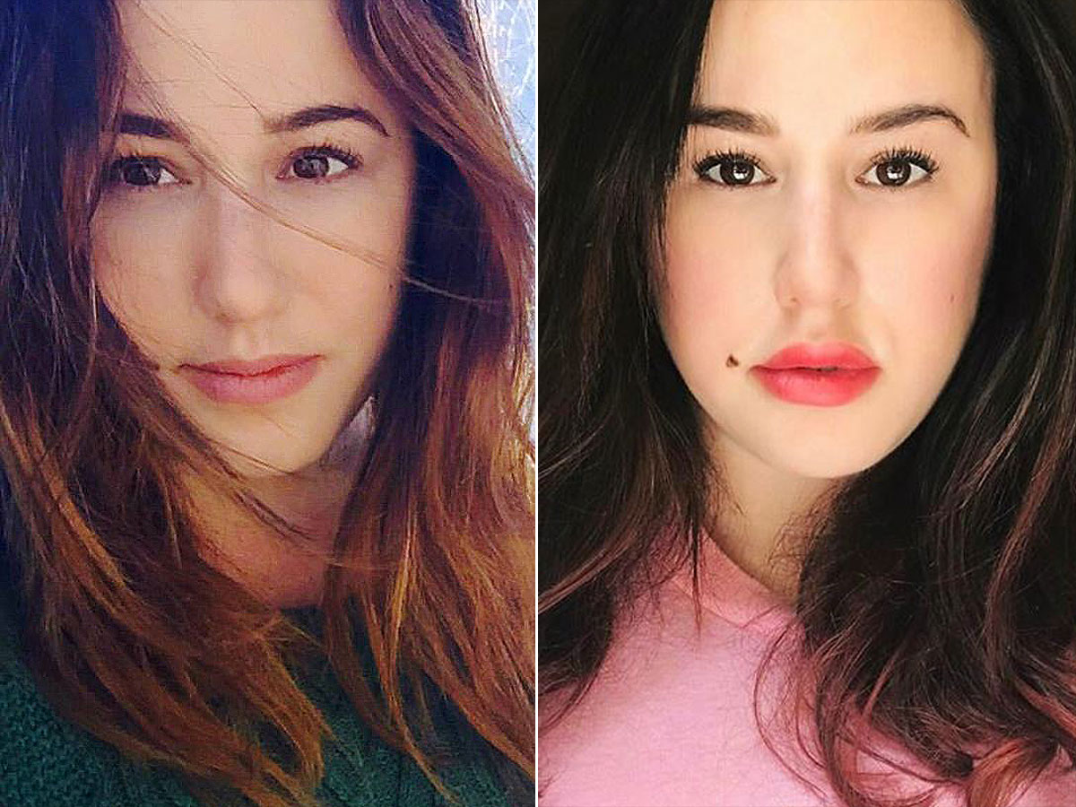 Before and after: Lip Filler Edition 