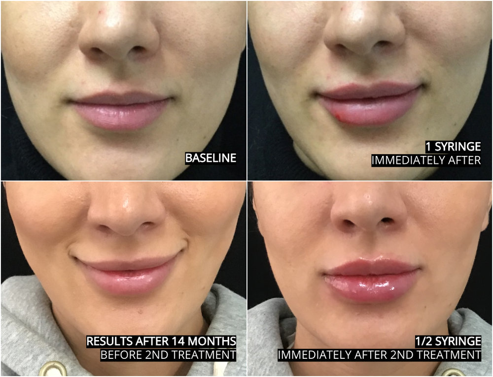 Before and after: Lip Filler Edition 