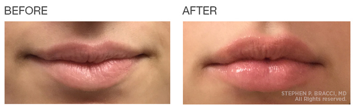 Before and after: Lip Filler Edition 