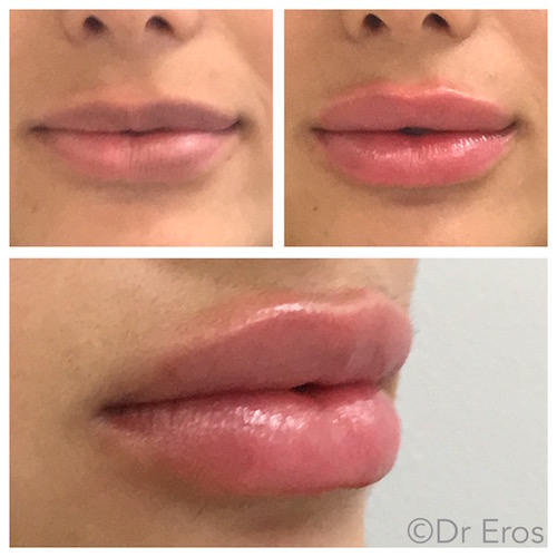 Before and after: Lip Filler Edition 