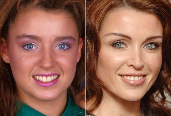 Celebrities Botox Before and After