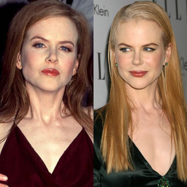Celebrities Botox Before and After