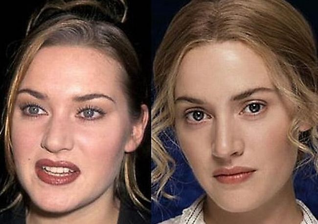 Celebrities Botox Before and After