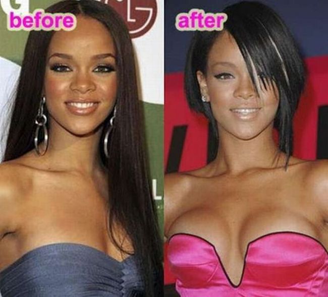Celebrities Botox Before and After.